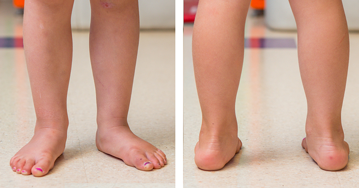 Front and back view of ankle pronation