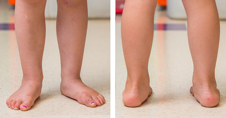 baby walking on inside of foot