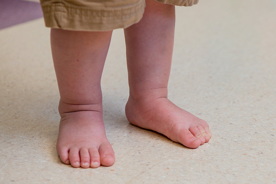 Flat Feet In Kids - Problems, Causes 