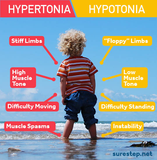 hypertonia versus hypotonia