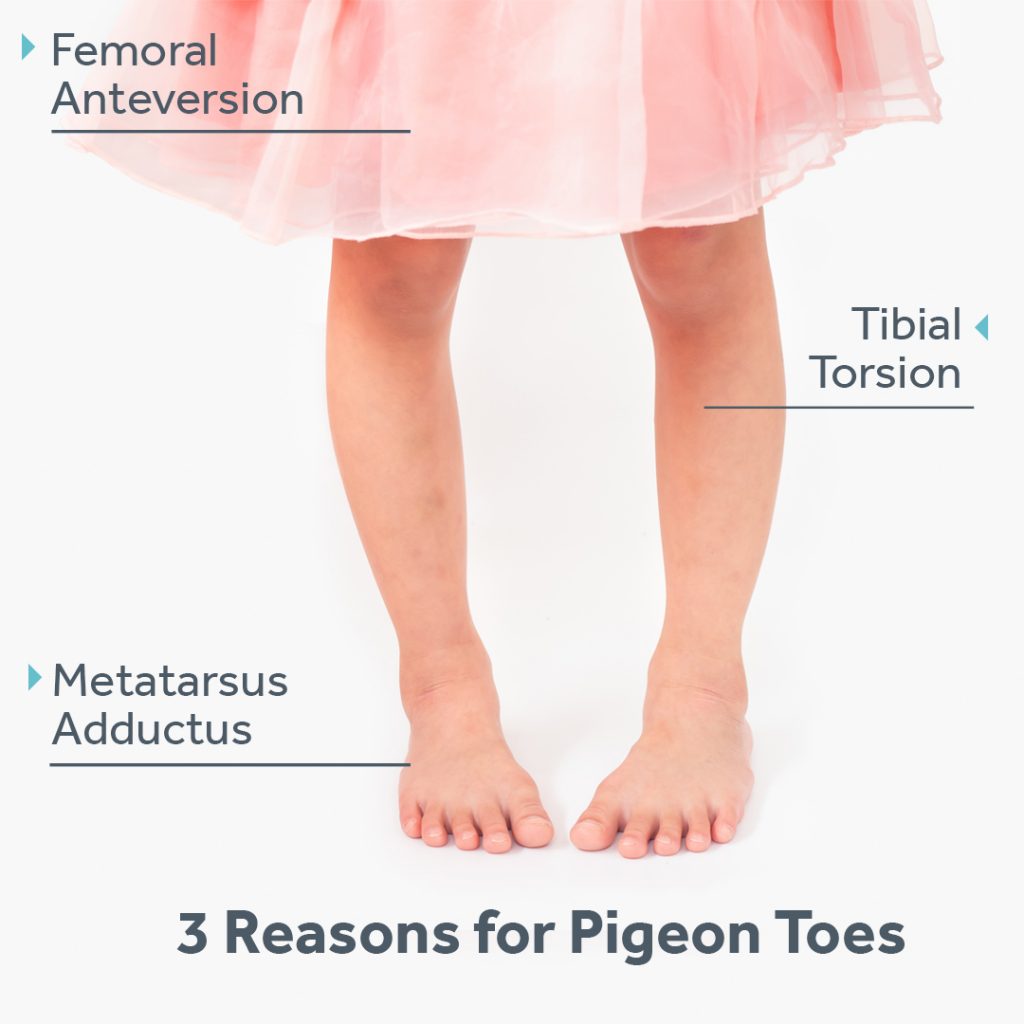 3 Reasons For Pigeon Toes