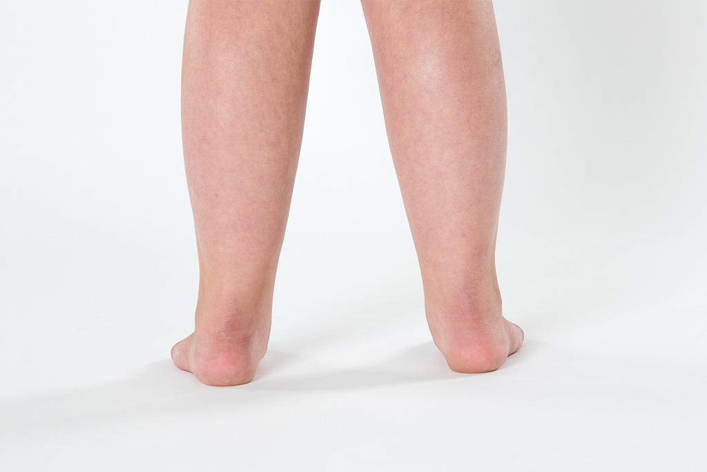 Pediatric Pronation Flat Feet