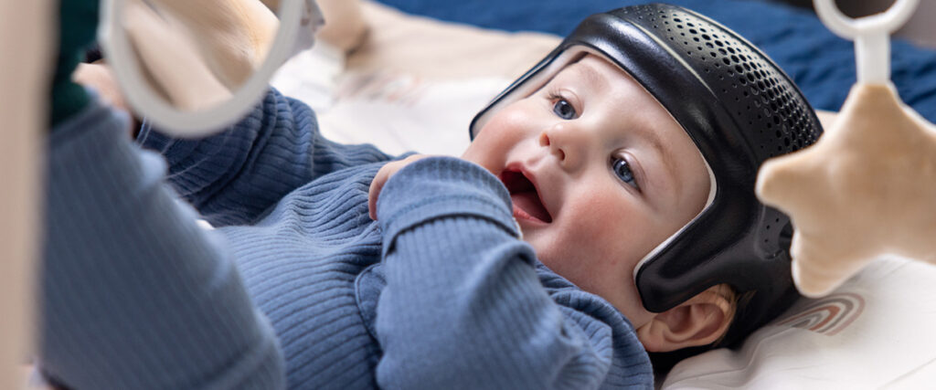 Photo - Milo in a Cranial Remolding Orthosis