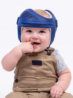 Sprout3D Cranial Remolding Orthosis